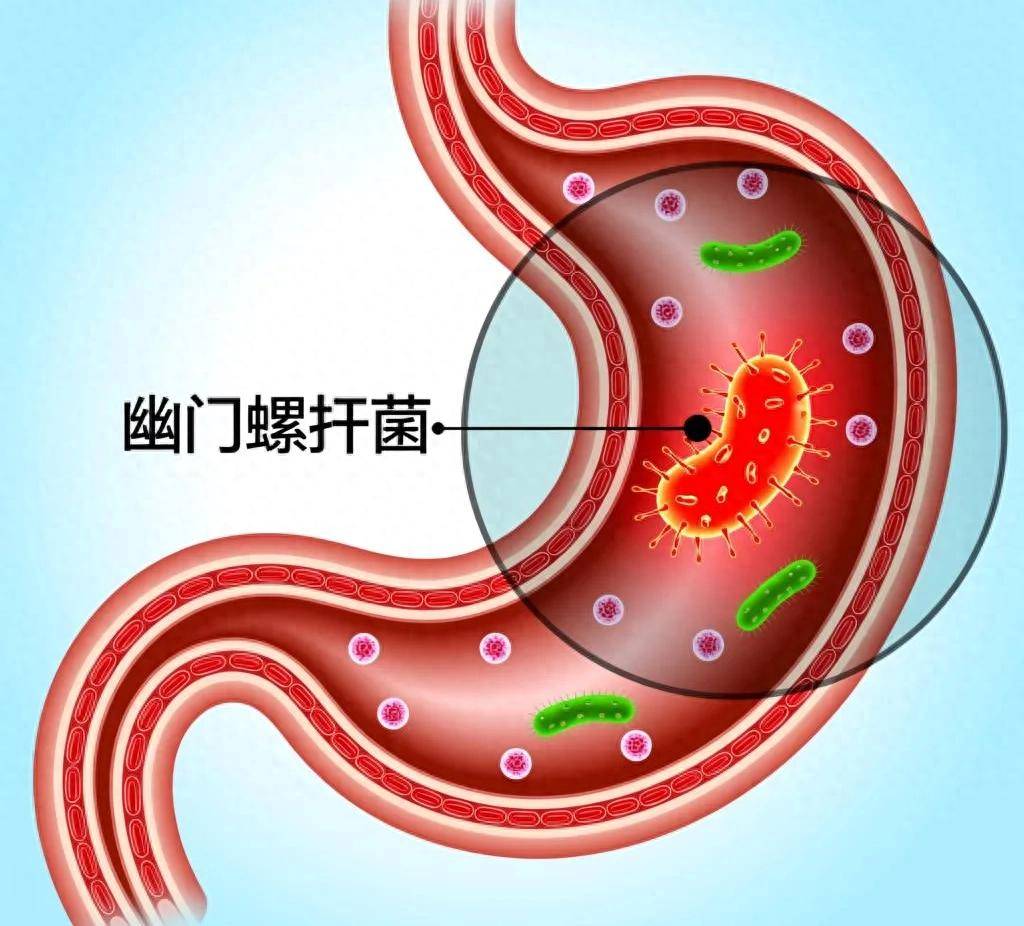 幽门螺杆菌反复感染？600+例临床数据告诉你，除了杀菌还需要做什么
