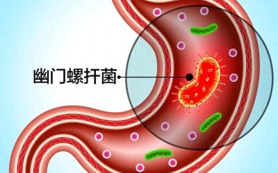 幽门螺杆菌反复感染？600+例临床数据告诉你，除了杀菌还需要做什么